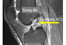 Hình 3. Tổn thương dây chằng chéo trước trên phim MRI