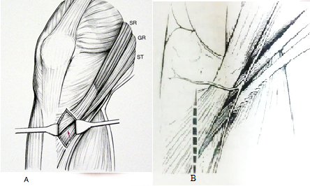 gân cơ thon và gân cơ bán gân