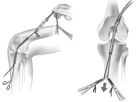 Các phương pháp phẫu thuật tái tạo dây chằng chéo trước khớp gối