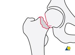 femoral neck frct