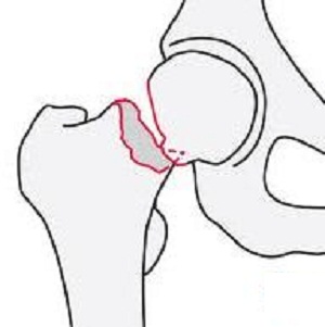 femoral neck frct