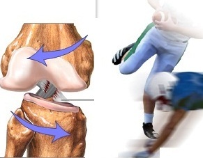 acl1