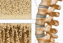 Loãng xương có thể nhầm với đau cột sống
