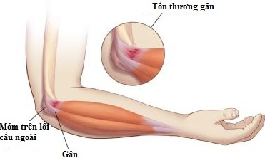 Mỏm Trên Lồi Cầu Xương Cánh Tay: Cấu Tạo, Chức Năng Và Phương Pháp Điều Trị